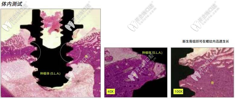 種植體親水性好 種植體親水性好