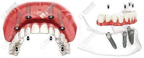 即刻負(fù)重種植牙 即刻負(fù)重種植牙