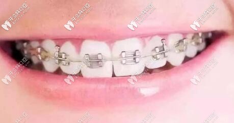 缺一兩顆牙是種植牙好還是牙齒矯正好?這些因素你考慮了嗎