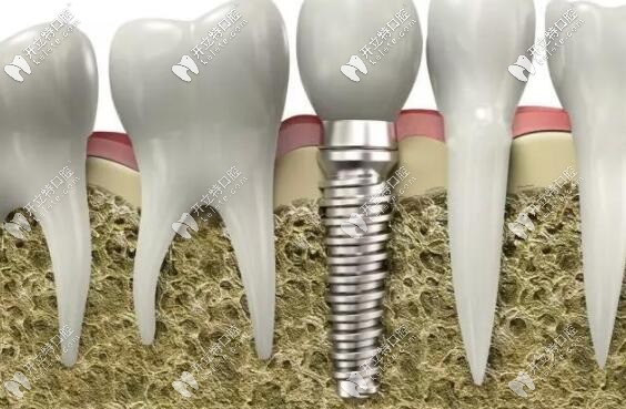 種植牙