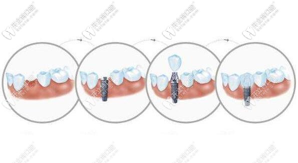 上海連鎖口腔復(fù)工了~韓國(guó)neo種植體包干價(jià)格很實(shí)在！