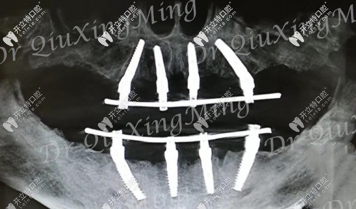 all-on-4全口種植牙技術(shù)