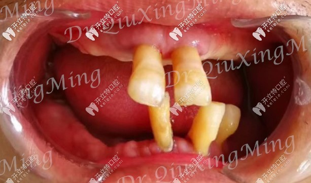大爺口腔剩余牙齒圖