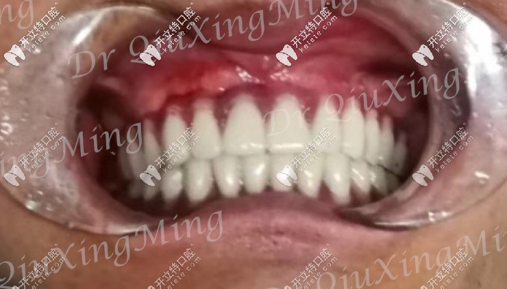 全口種植牙效果圖
