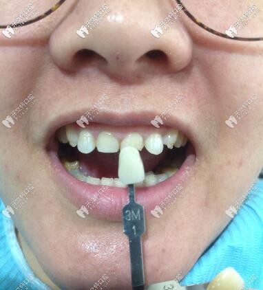 唐山誠品口腔門診部瓷貼面真人案例