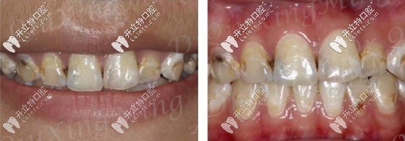 牙齒貼面修復前的口內照