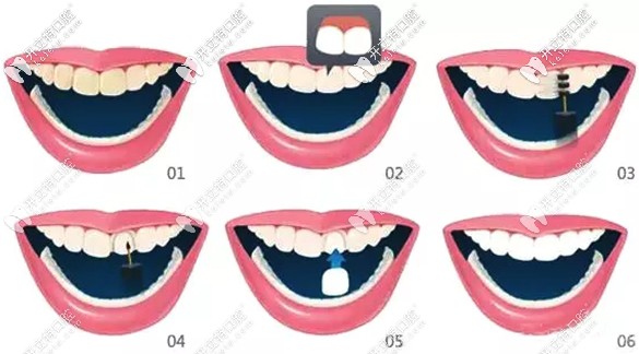 牙貼面修復過程圖