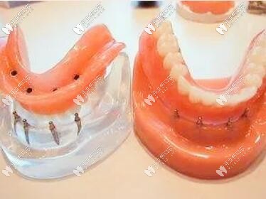 活動(dòng)假牙可以換購(gòu)種植牙是真的