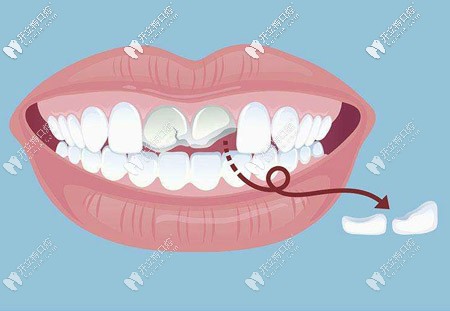 江湖救急!請問門牙斷了一半做補牙的價格是多少啊