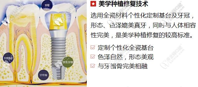 貴陽(yáng)柏德口腔美學(xué)種植修復(fù)技術(shù) 貴陽(yáng)柏德口腔美學(xué)種植修復(fù)技術(shù)