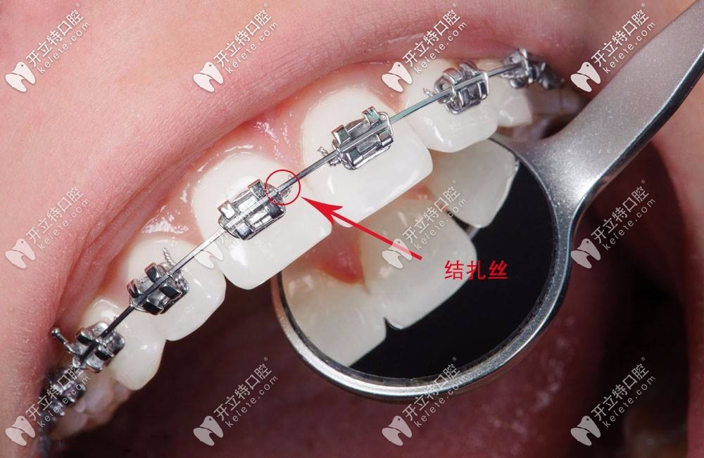 進口自鎖金屬托槽