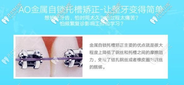 AO自鎖托槽矯正