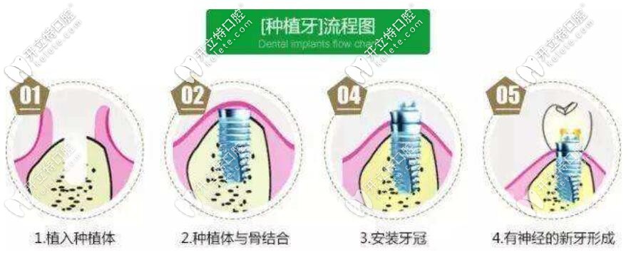 種植牙流程