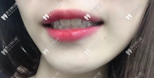 矯正后的效果圖，略微有點(diǎn)內(nèi)頃