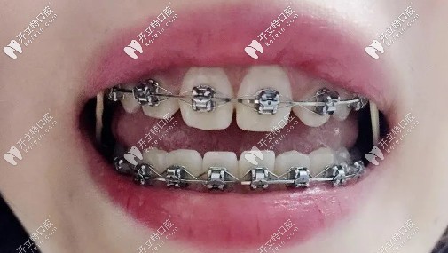 左右各一根橡皮筋，收縫