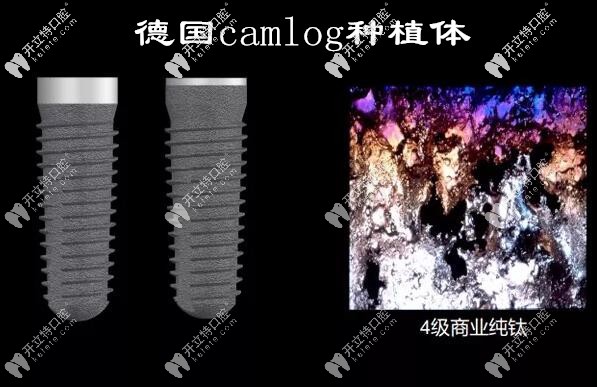 德國(guó)camlog種植體的材質(zhì)
