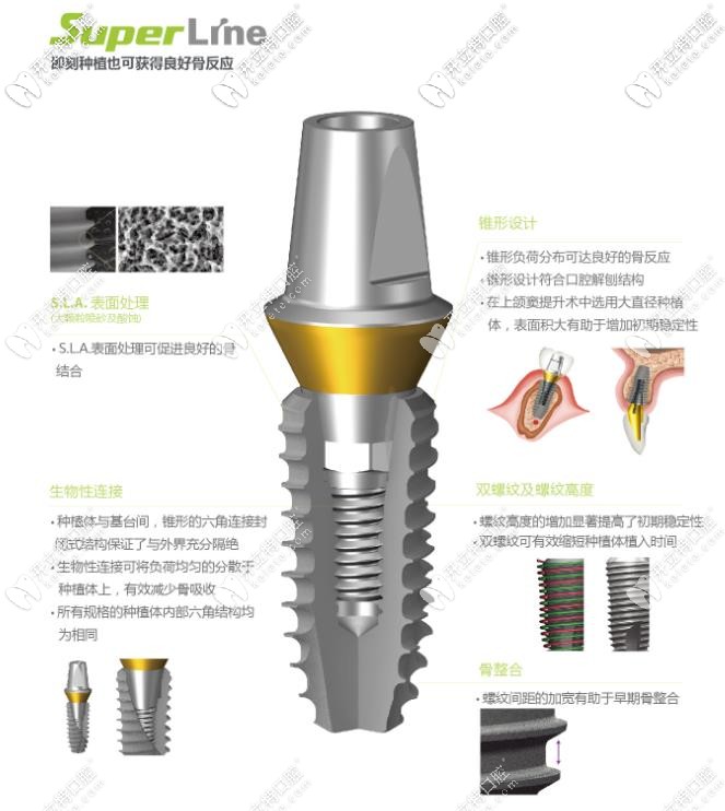 登騰superline種植體型號(hào)