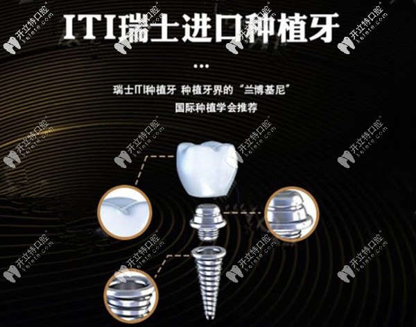 iti種植體的外觀示意圖