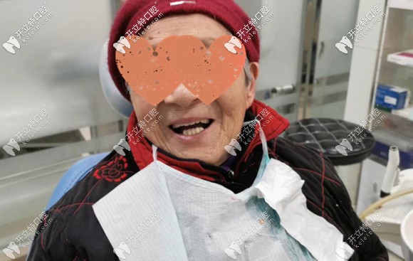 用美國百康種植體做的半口種植牙