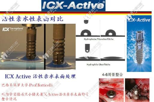 ICX種植體的表面處理技術