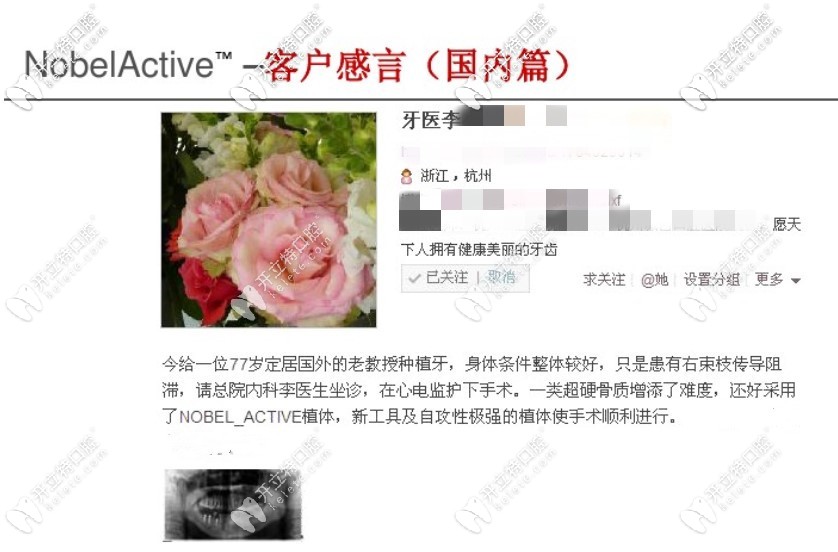 瑞典nobel種植體active醫(yī)生使用后反饋