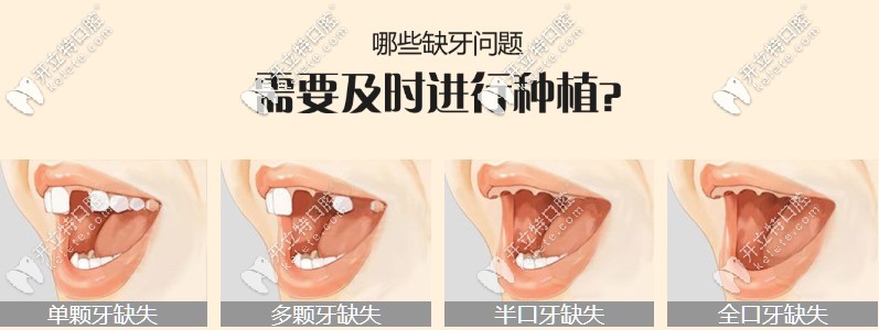 對(duì)于單顆和多顆牙齒缺失問(wèn)題是需要種植的