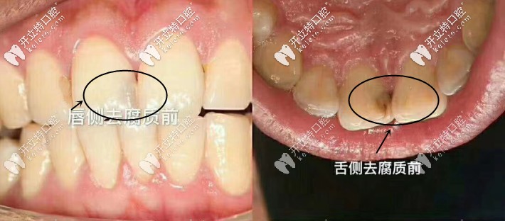 唇舌側(cè)去腐質(zhì)前的照片