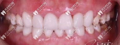 昆山美奧張牙齒貼面案例