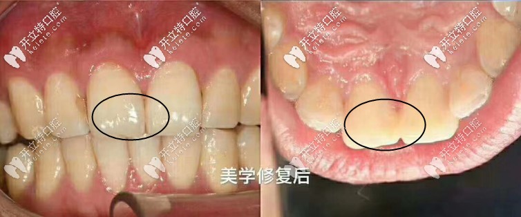 二氧化鋯全瓷嵌體修復(fù)一年后的效果
