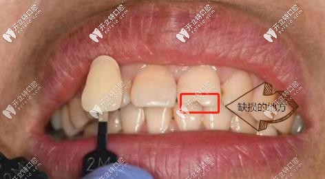 牙齒缺損的地方