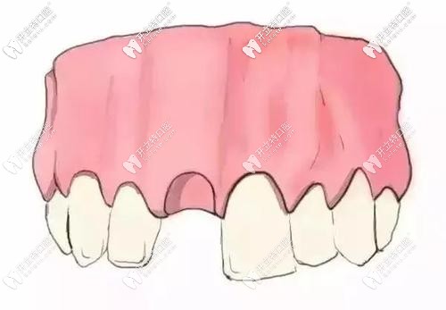 牙齒缺失外觀圖