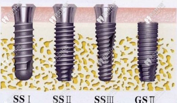 奧齒泰種植體表面處理方式