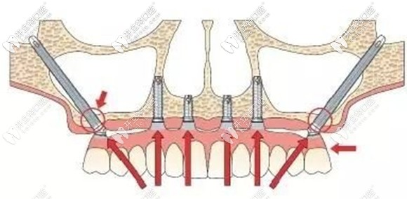 什么是穿顴穿翼種植牙技術(shù)