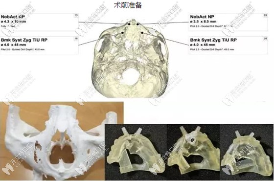 做好術(shù)前準(zhǔn)備可避免穿顴穿翼種植并發(fā)癥的發(fā)生