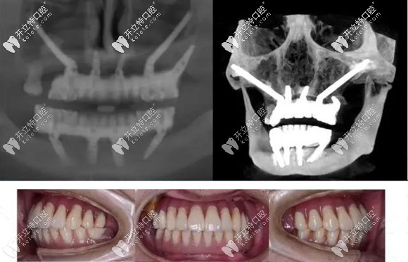 客觀來說做穿顴穿翼板種植牙是利大于弊