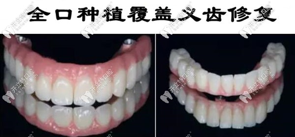 Locator種植覆蓋義齒的費用和圖片,送給全口無牙頜的伙計們