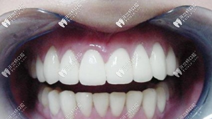 失敗的牙齒貼面效果