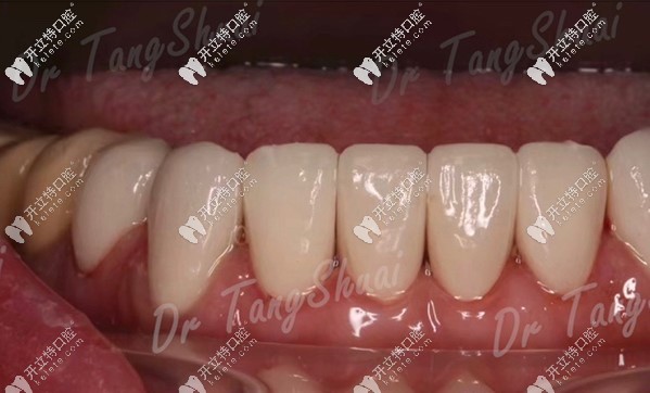 下牙做8顆貼面效果