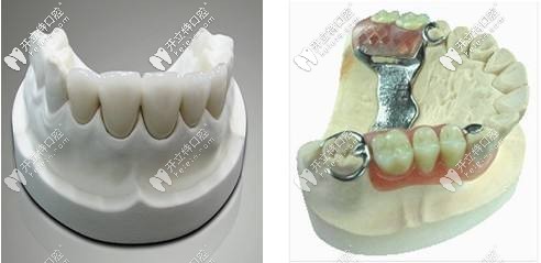 固定義齒 固定義齒