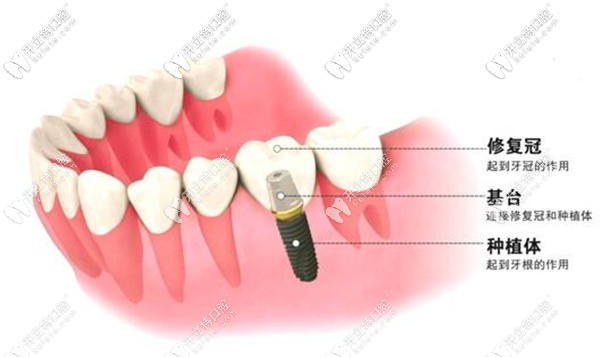 缺一顆牙可以做種植牙修復