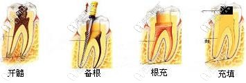 開髓、備根、根充以及填充