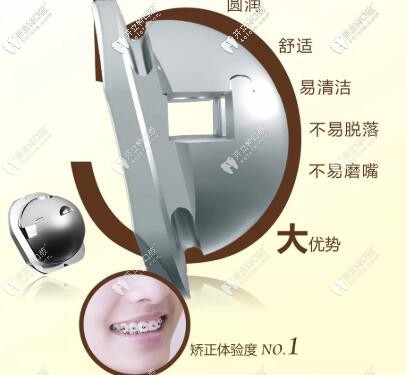 球托(OBrace)自鎖托槽的優(yōu)勢