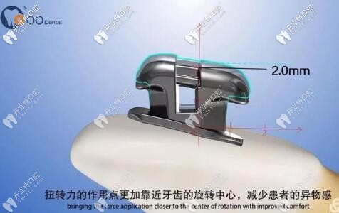 歐睛(O-Eyes)自鎖托槽優(yōu)點(diǎn)