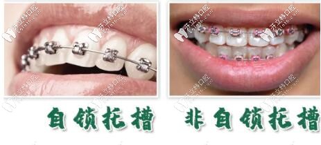 細(xì)說國產(chǎn)自鎖托槽品牌歐睛和OBrace球托的區(qū)別及價(jià)格