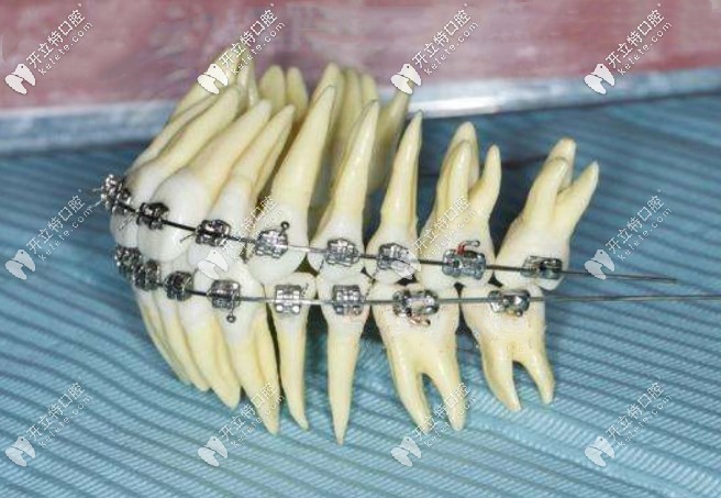 何為直絲弓矯正技術(shù)