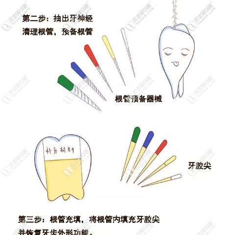 牙齒根管治療步驟