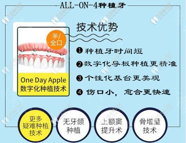 海口鼎點口腔allon4全口半口種植牙技術