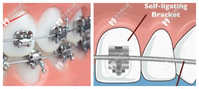 金屬托槽和自鎖托槽區(qū)別圖