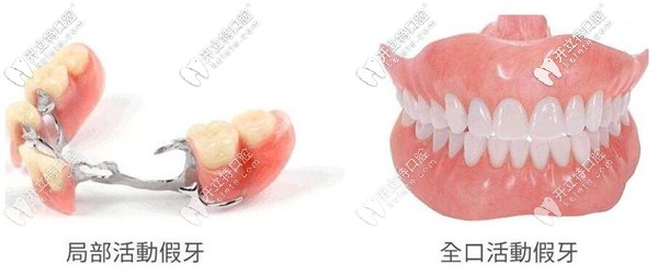 活動(dòng)假牙的價(jià)格