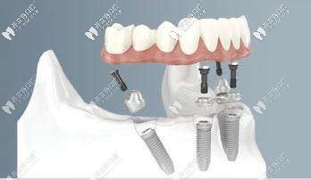 全口種植體以傾斜角度植入